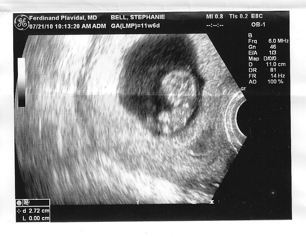 ultrasound photo